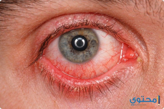 علاج التهاب العين في المنزل