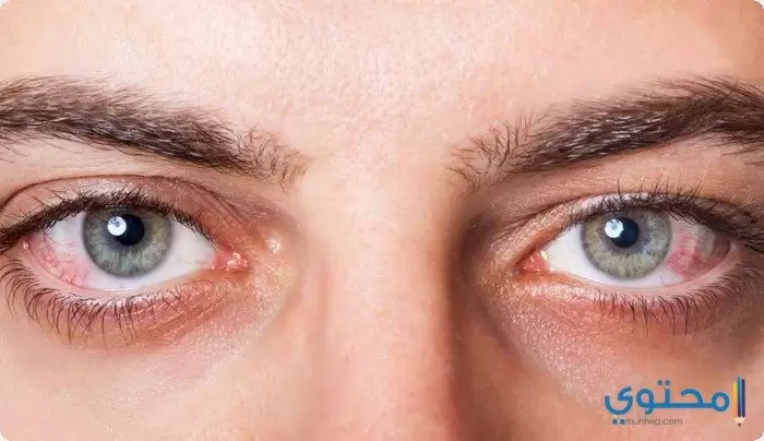 علاج التهاب العين واحمرارها