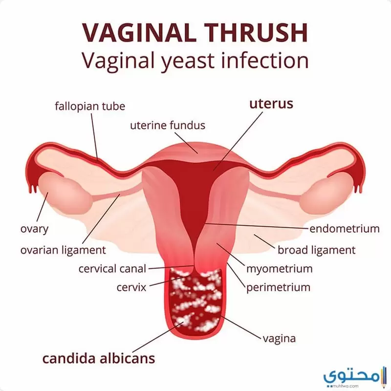 علاج التهابات المهبل