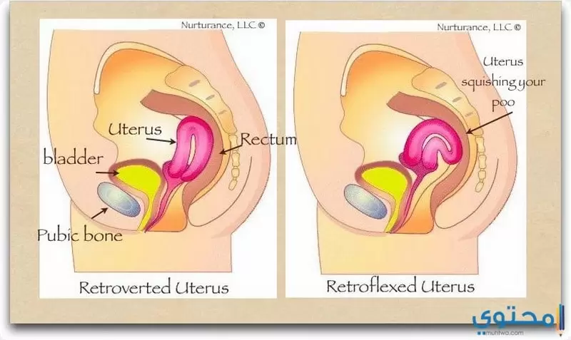 علاج الرحم المقلوب3