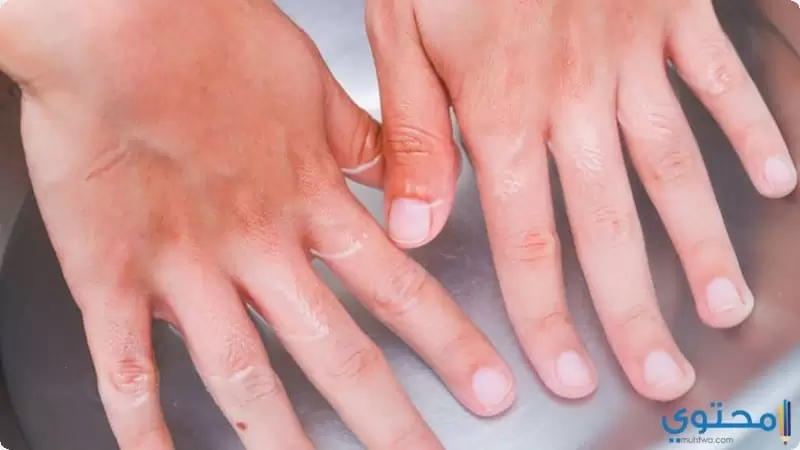 علاج الزوائد الجلدية حول الاصابع2