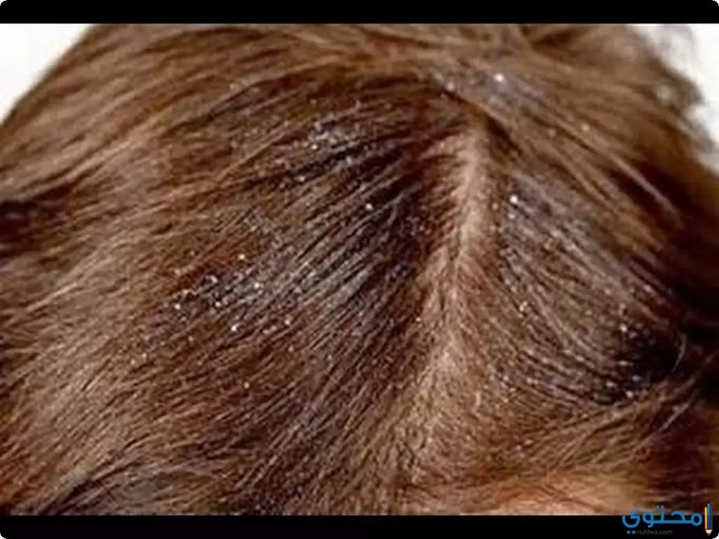 علاج الشعر من القشرة للنساء