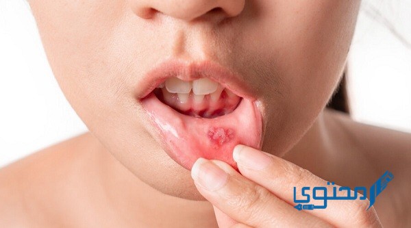 طريقة علاج تقرحات الفم بالملح وما هو علاج تقرحات الفم واللسان ؟