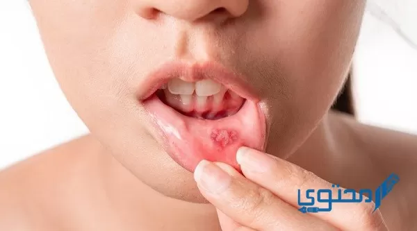طريقة علاج تقرحات الفم بالملح