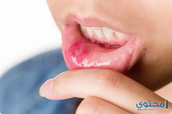 علاج تقرحات الفم واللثة2