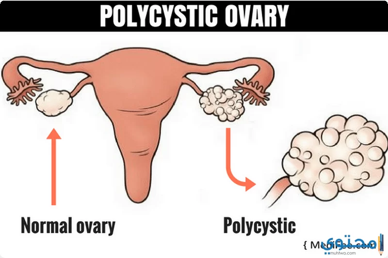 طرق علاج تكيس المبايض للمتزوجة وعند البنات