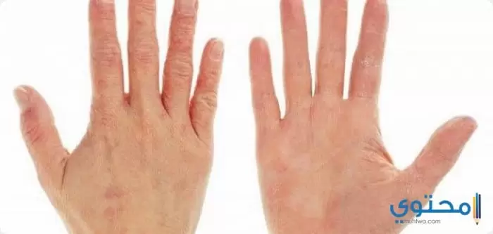 علاج جفاف وخشونة اليدين