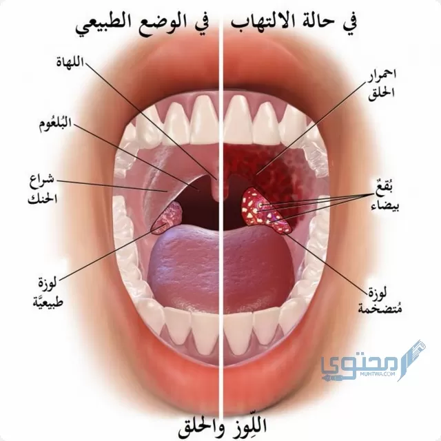 علاج حصى اللوزتين بالأعشاب