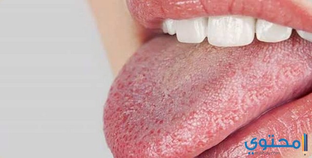 ادوية علاج فطريات الفم موقع محتوى