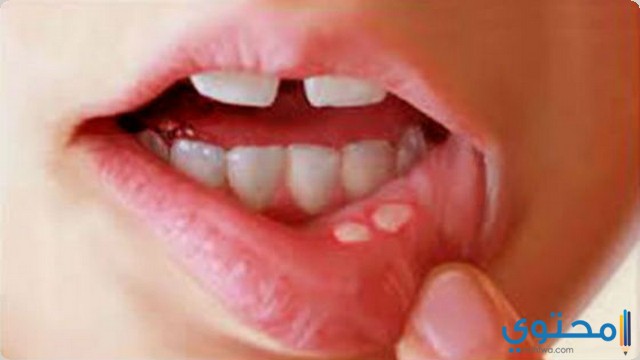 ادوية علاج فطريات الفم موقع محتوى