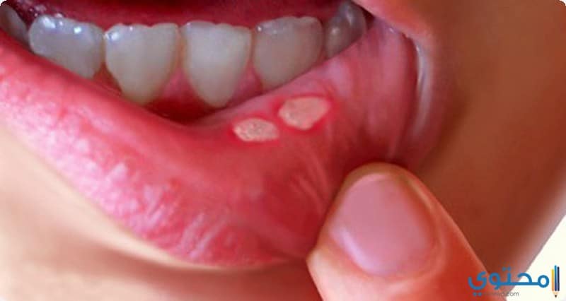 علاج قرحة الفم بأحدث الطرق العلاجية