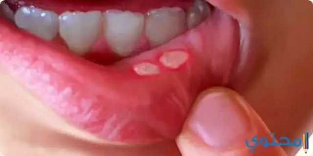 علاج قرحة الفم 7