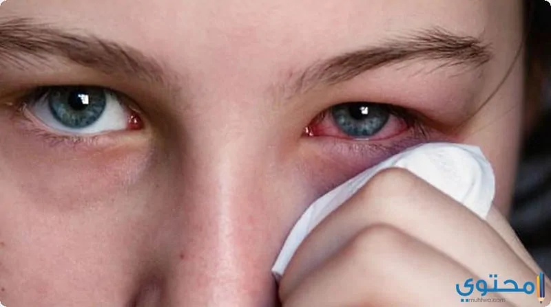 علاج كدمات العين 2