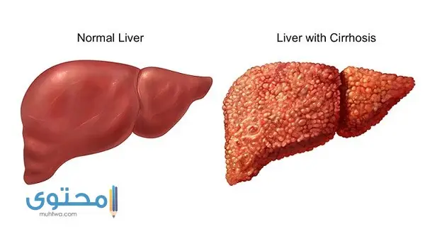 كم يعيش مريض استسقاء الكبد
