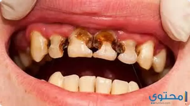 ما هو تسوس الأسنان 24