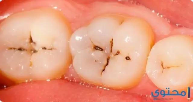 علاج تسوس الاسنان