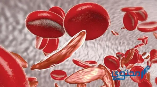 ما هو فقر الدم المنجلي – الأعراض والأسباب