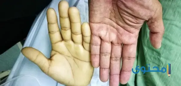 ما هي أعراض فقر الدم عند النساء والرجال