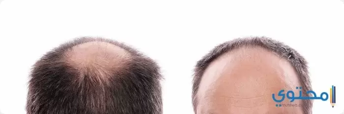 عمليات زراعة الشعر الناجحة