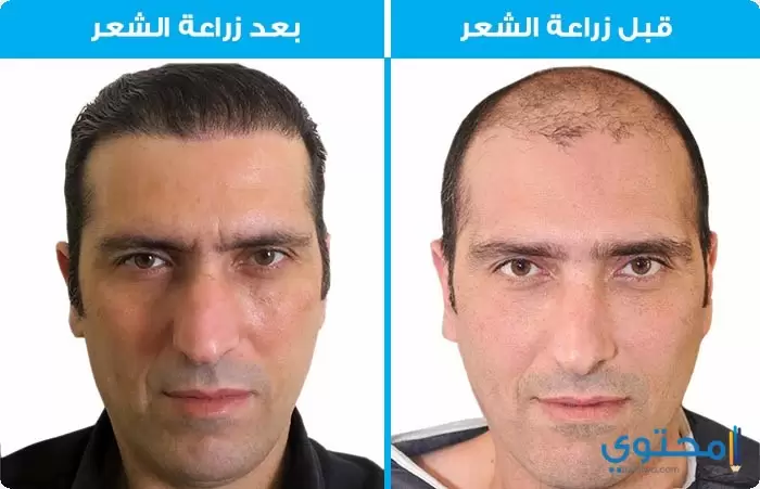 زراعة الشعر في مصر عن طريق الاستخراج