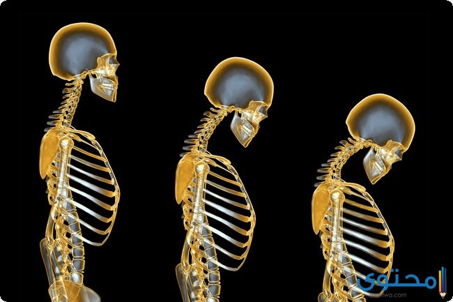 اذاعة مدرسية عن هشاشة العظام 1 اذاعة مدرسية عن هشاشة العظام