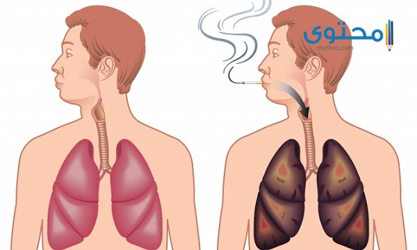 هل تعود الرئة لحالتها الطبيعية بعد الإقلاع عن التدخين؟