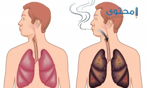 هل تعود الرئة لحالتها الطبيعية بعد الإقلاع عن التدخين