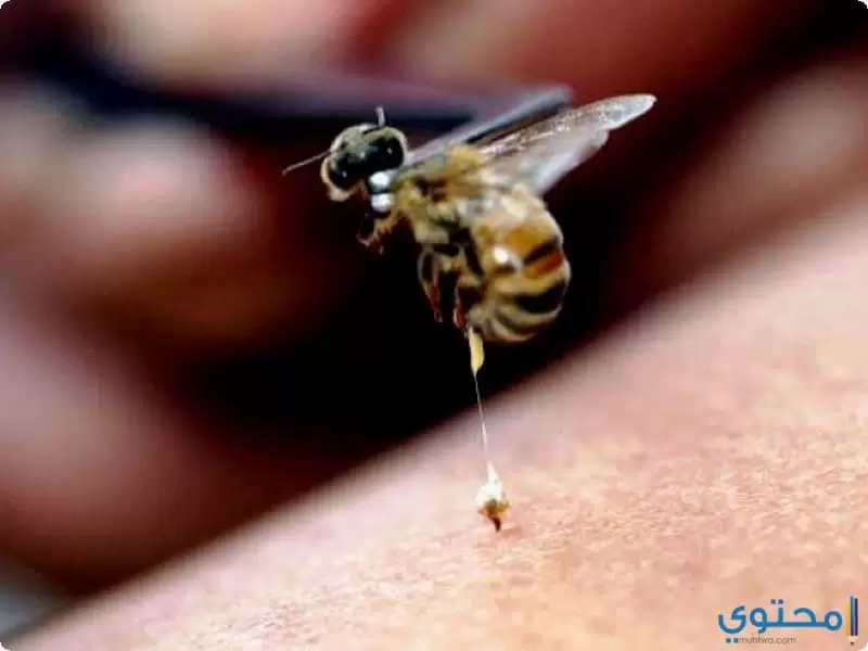 وصفات طبيعية لعلاج لسعة النحلة